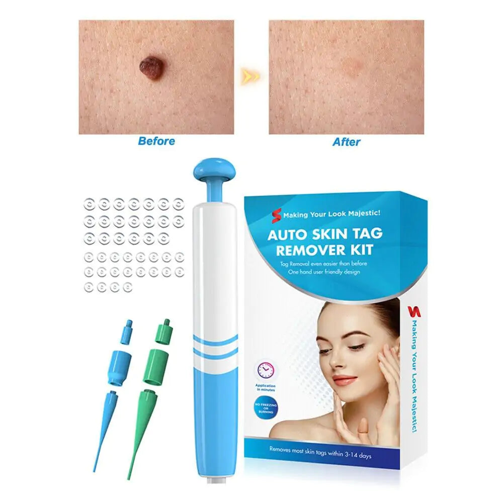Painless Skin Tag Removal Kit